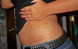 Home Remedies For Stretch Marks That Actually Works