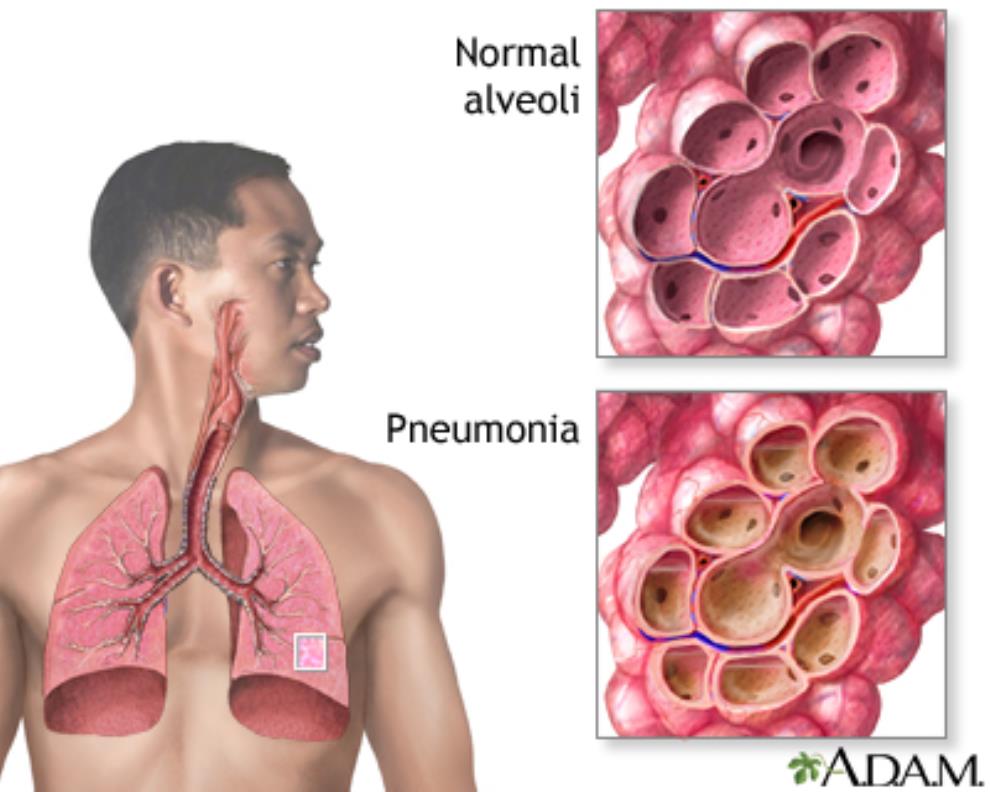 Young Children And Adults Above 65years Are Most Prone To Pneumonia
