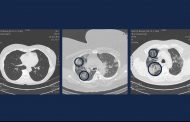 Lung scans of COVID-19 patients in their 30s show 