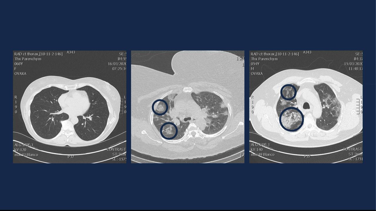 Lung scans of COVID-19 patients in their 30s show 